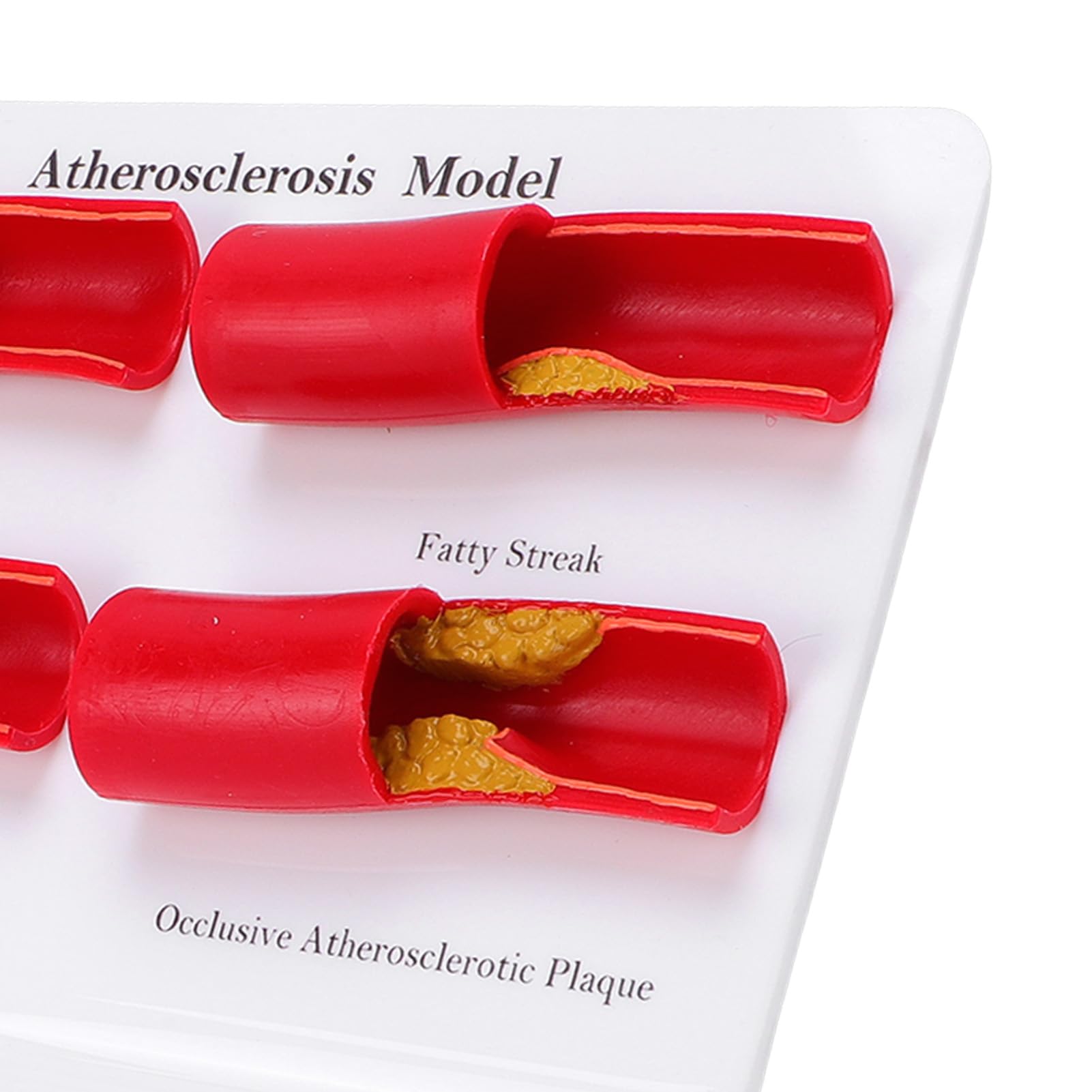 Generic Atherosklerose-Modell. Anatomisch Genaue Darstellung Arterieller Verstopfungen. Einfaches Wartungsdesign für Klinische Umgebungen