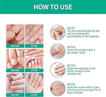 FUNGUS 完売間近！！ Kerassentials Toenail Fungus Treatment Oil, 2023 New