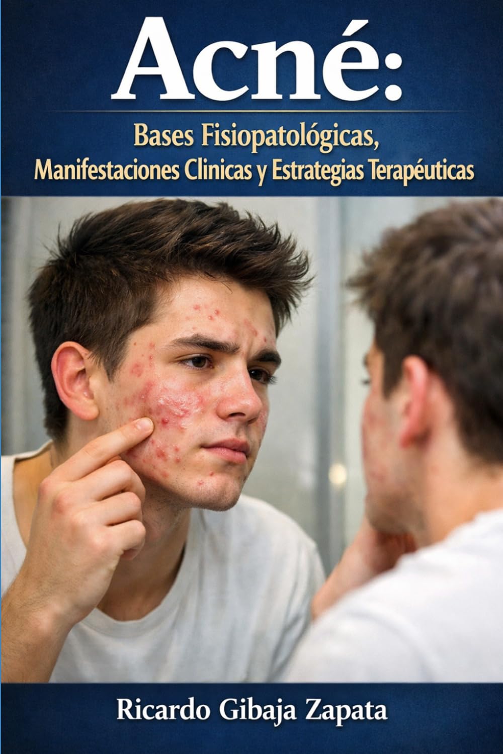 Acné: Bases Fisiopatológicas, Manifestaciones Clínicas y Estrategias Terapéuticas