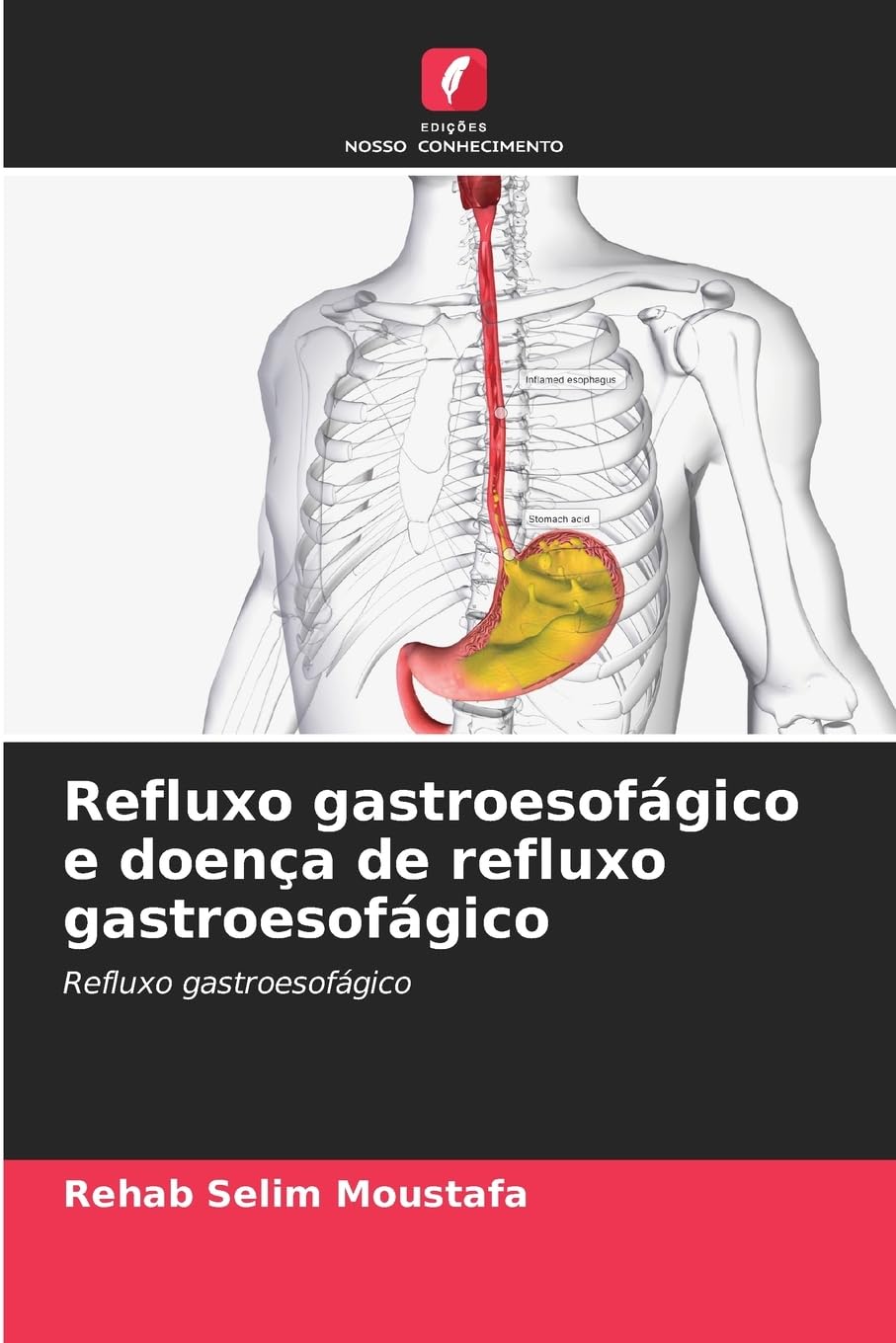 Refluxo gastroesofágico e doença de refluxo gastroesofágico: Refluxo gastroesofágico