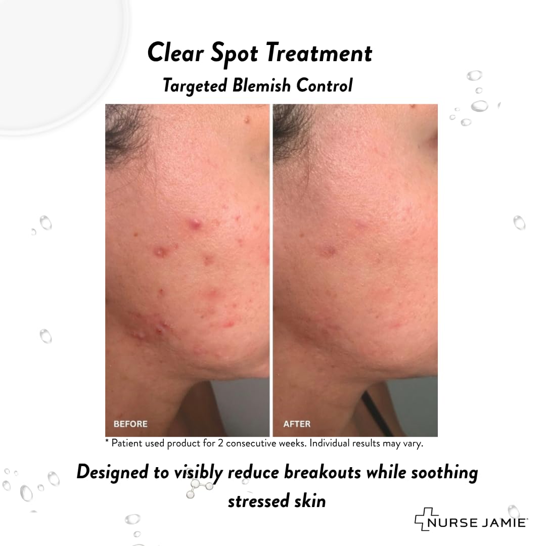 Nurse Jamie Clear Spot Treatment – Fast-Acting Overnight Blemish Treatment with Salicylic Acid, Glycolic Acid & Sulfur