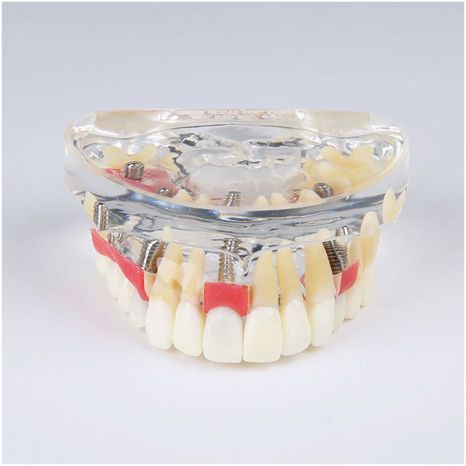 Sjdopulse Teeth Implant Model - Dental Implant Upper Overdenture Restoration Model - Dental Teeth Study Teaching Model With Abutment, Implant Nail, Soft Gum