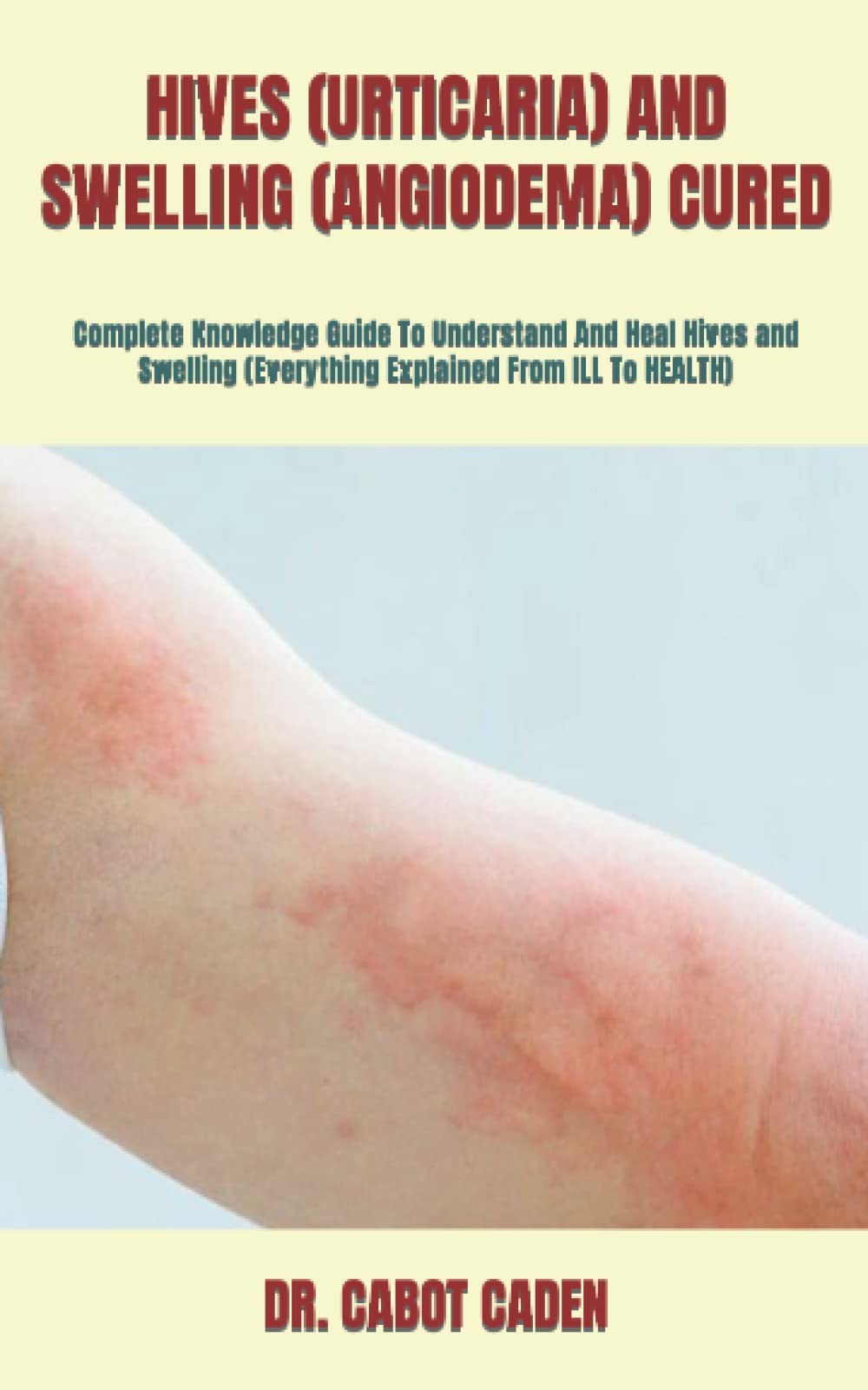 Buy HIVES (URTICARIA) AND SWELLING (ANGIODEMA) CURED Complete