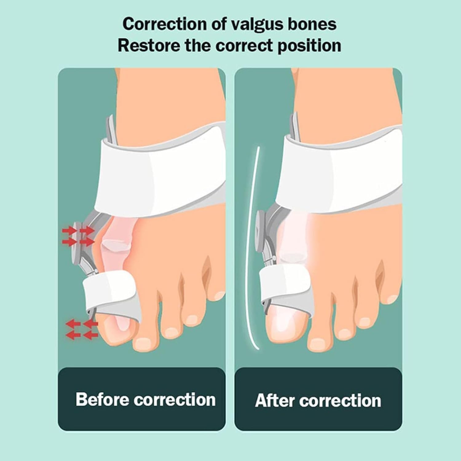 Ortesis para juanetes, enderezador del Dedo Gordo del pie, férula Ajustable para juanetes con corrección de Perilla, restauración del Arco Transversal Correcto, corrección del Hallux valgus