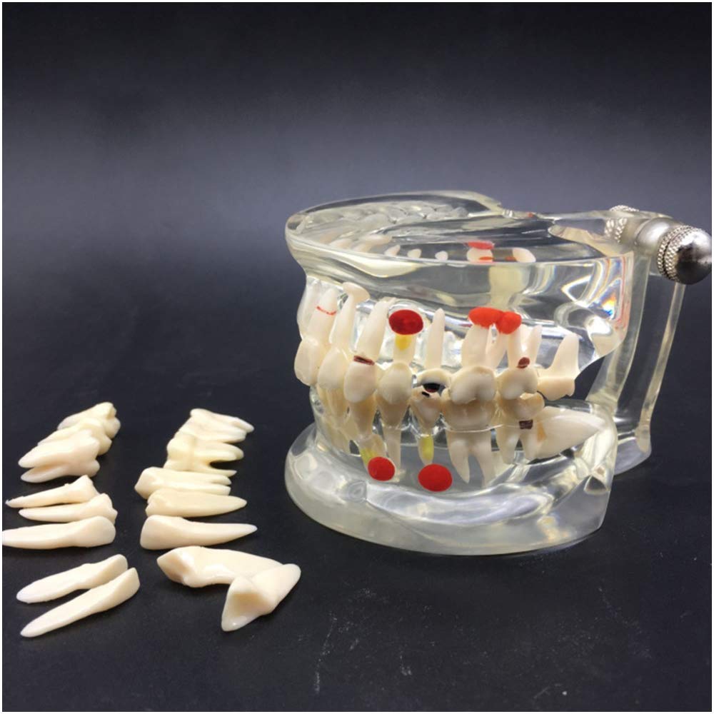 Sjdopulse A Dult Pathology Teeth Model - Teeth Teaching Model - Hemi-Extractable Tooth Model - Simulation Oral Tooth Teeth Demonstration Model - For Study Teaching (A)