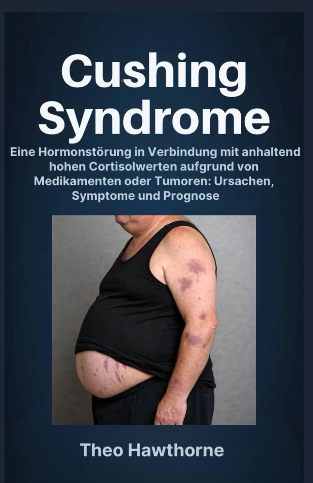 Cushing Syndrome: Eine Hormonstörung in Verbindung mit anhaltend hohen Cortisolwerten aufgrund von Medikamenten oder Tumoren: Ursachen, Symptome und Prognose