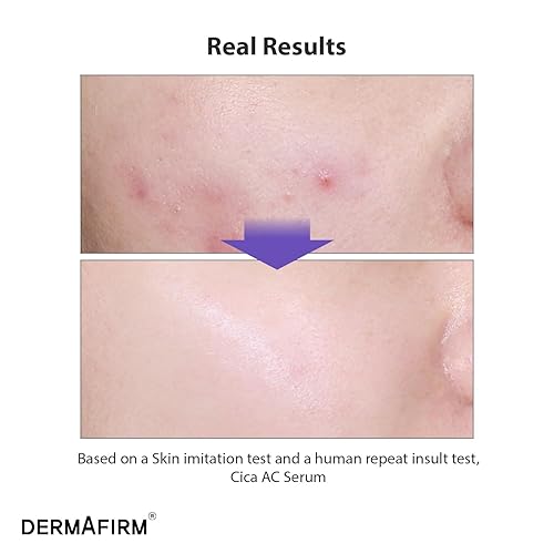 Miniatura 2 de DERMAFIRM CICA AC Serum para piel propensa al acné - Suero facial coreano con exosoma, centella asiática, niacinamida, ácido salicílico y vitamina