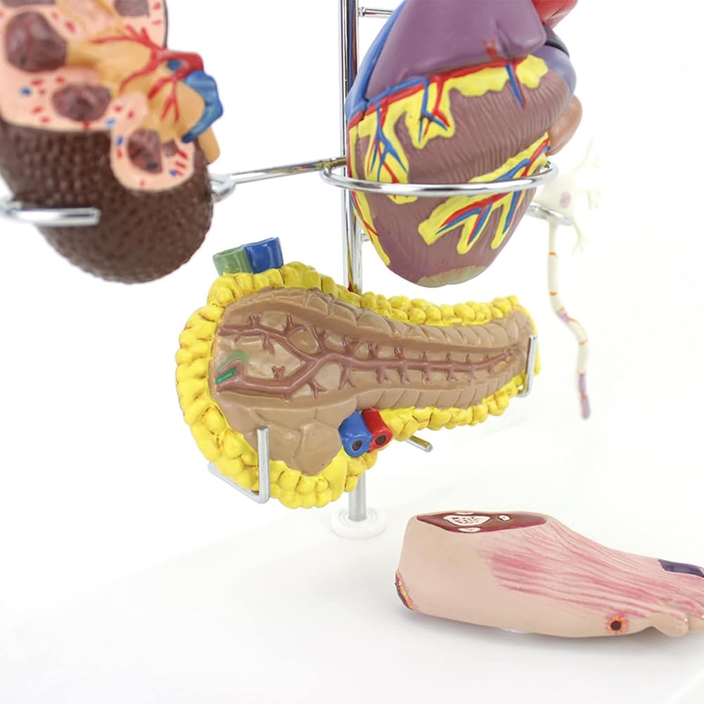 Medyczny Model Cukrzycy, Model Patologii Cukrzycy, Materiał PVC Patologia Cukrzycy Serce, 8 Części Zdejmowany Model Narządu Dla Studentów Anatomii I Fizjologii