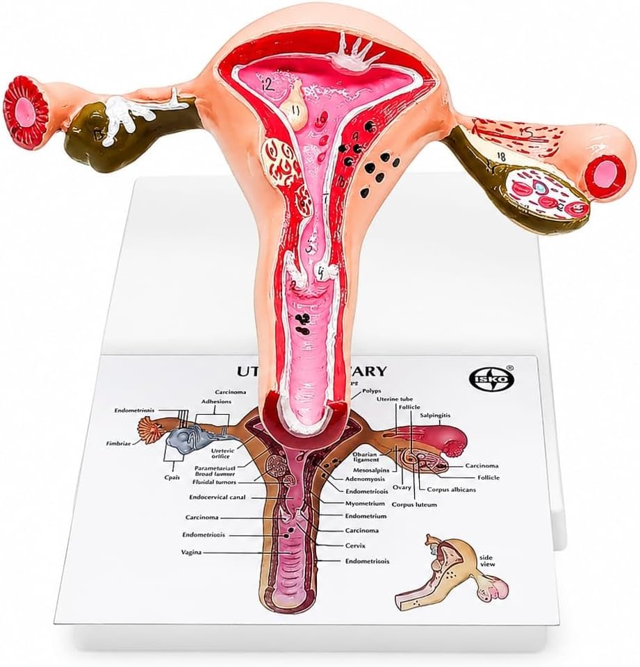ISKO® Uterus Ovary Model Body Anatomy Replica of Female Reproductive System Organ Anatomical Model with base showing the common Pathologies for Doctors Office Educational Tool