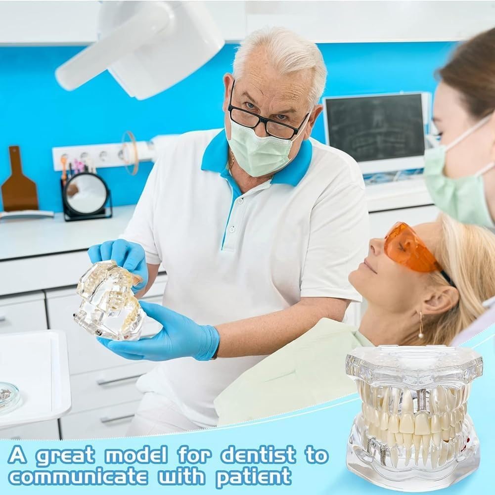 Modello di Denti Trasparente Modello di Malattie Dentali Typodont Dentale Modello di Denti per Impianti con Denti Rimovibili Dimostrazione Standard del Dente per Dentisti