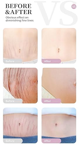 Miniatura 4 de Crema de estrías para el cuidado de la piel de maternidad posparto para barriga, senos, caderas y muslos, crema de estrías para embarazo,