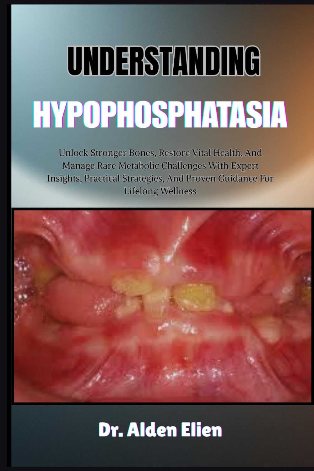 UNDERSTANDING HYPOPHOSPHATASIA: Unlock Stronger Bones, Restore Vital Health, And Manage Rare Metabolic Challenges With Expert Insights, Practical Strategies, And Proven Guidance For Lifelong Wellness