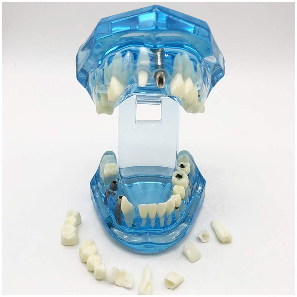 Modello di Denti da 2 Pezzi, Modello di Analisi di Studio di Impianti Dentali per Riparazione di Carie Dentale, Modello Dimostrativo per L'Insegnamento Medico, Forniture di Laboratorio