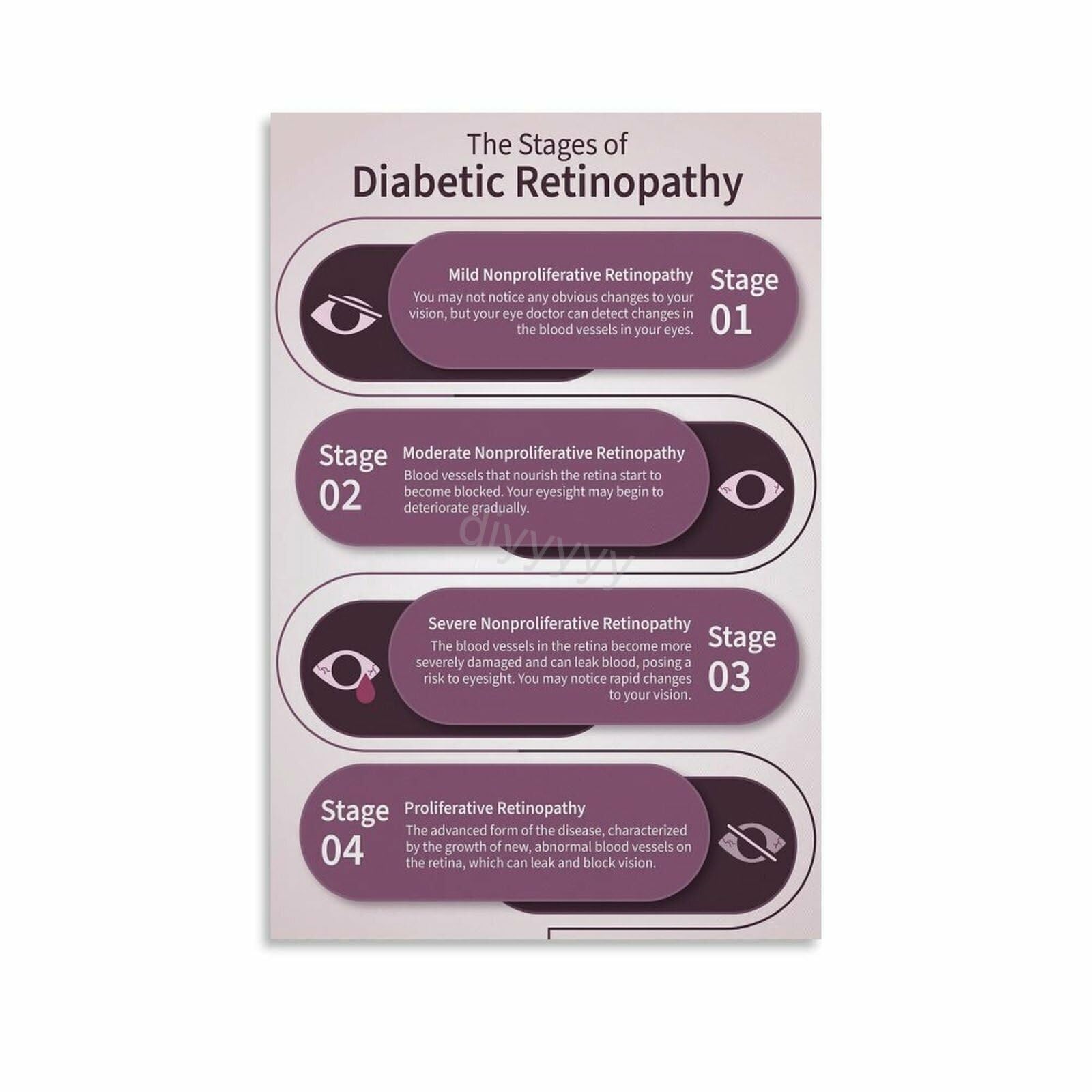 SSOPTMCB Diabetic Retinopathy Anatomy and Stages Poster Educational Visual Guide Eye Disease Symptoms Chart for Patient Education Clinic Hospital Decor(Unframed,08x12inch(20x30cm))