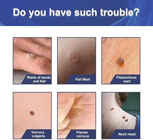 Miniatura 3 de Thcbme Máscara líquida de gel para verrugas y maíz de máxima fuerza, fórmula exclusiva para eliminar rápidamente las verrugas plantares, verrugas