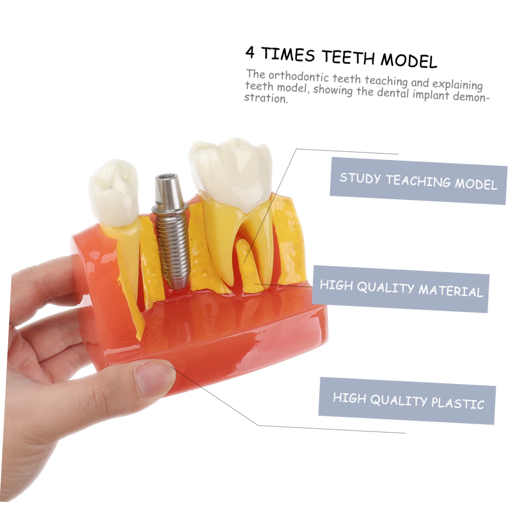 1pezzi Modello di Denti con Denti Rimovibili Strumento Didattico per Insegnamento e Studio Odontoiatrico Modello di Impianto e Protesi Fissa Incluso