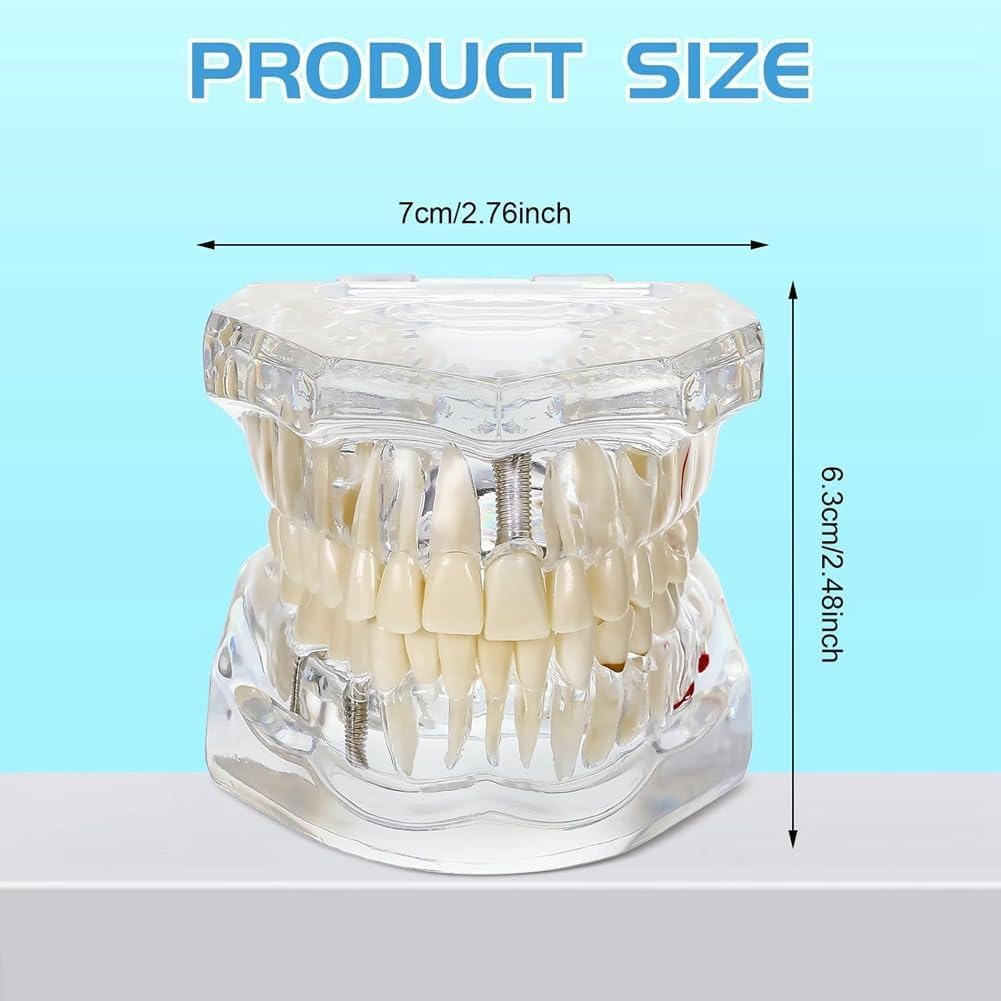 Modello di Denti Trasparente Modello di Malattie Dentali Typodont Dentale Modello di Denti per Impianti con Denti Rimovibili Dimostrazione Standard del Dente per Dentisti