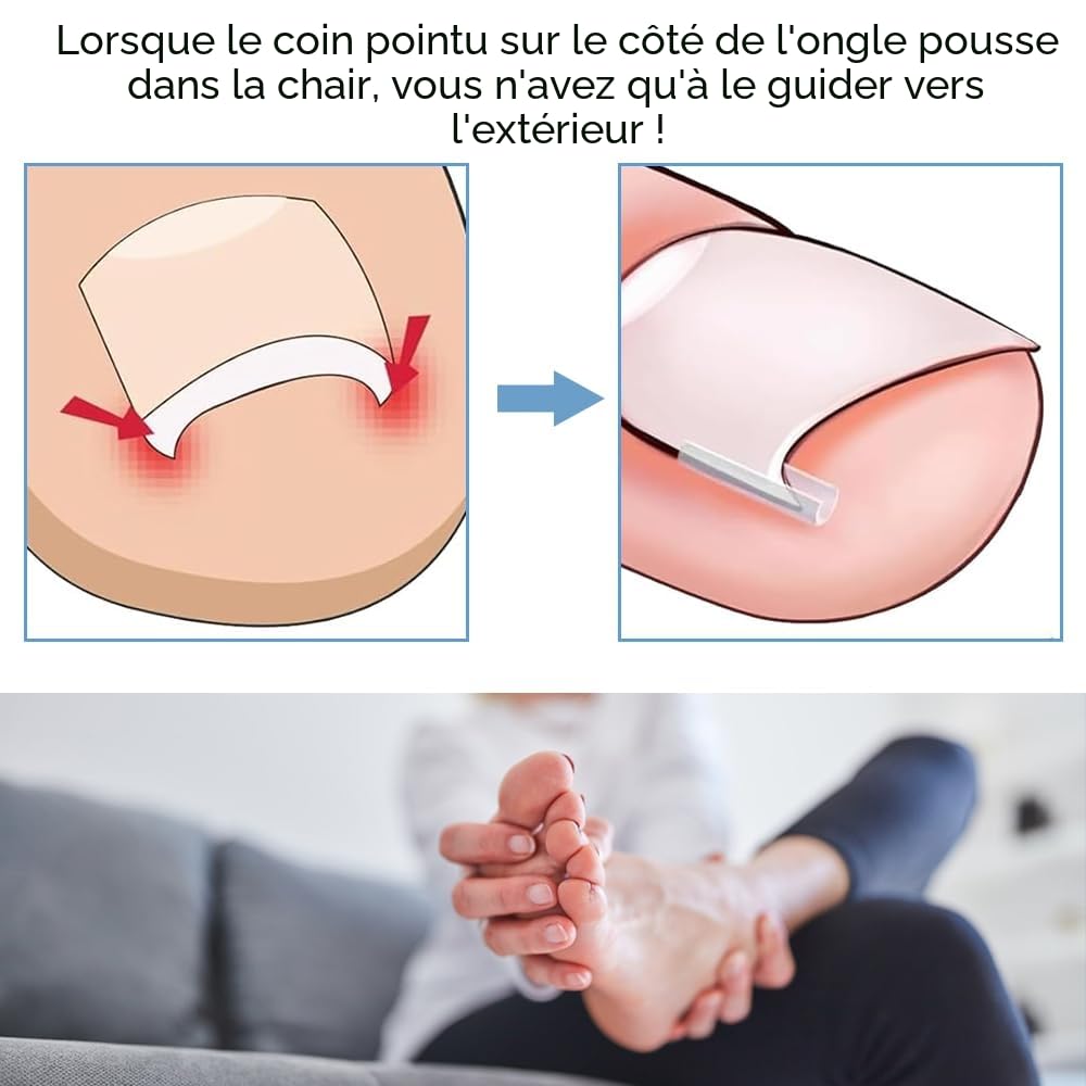 Ensemble Correcteur d'Ongles Incarnés - 50 Bandes Sans Douleur pour Redresser les Ongles avec Élévateur d'Ongles - Kit Facile à Utiliser d'Outils pour Ongles Incarnés