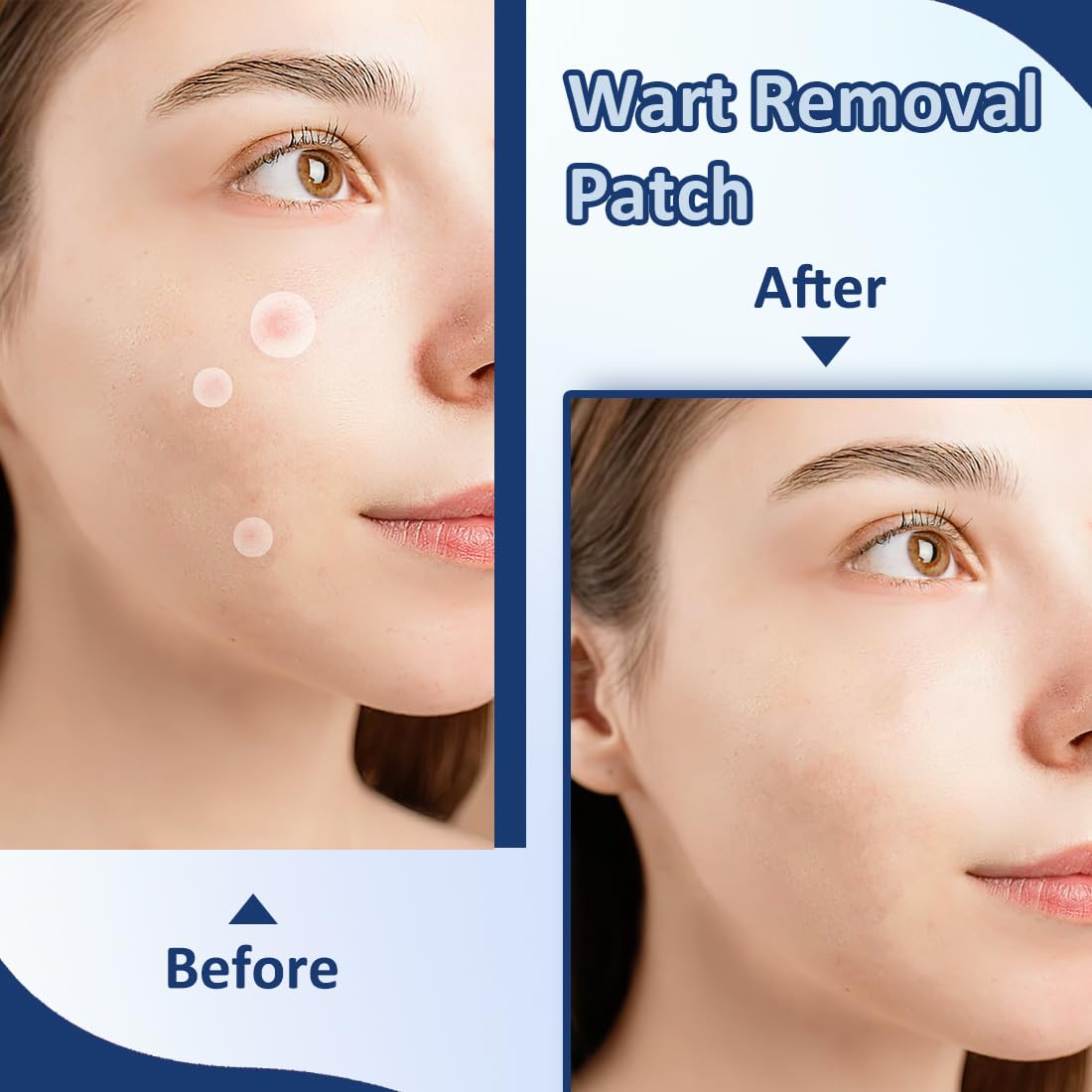 EIHI 288 parches para verrugas, parches para verrugas, fórmula suave, tratamiento efectivo, natural, parches para verrugas faciales y corporales, tratamiento indoloro y efectivo