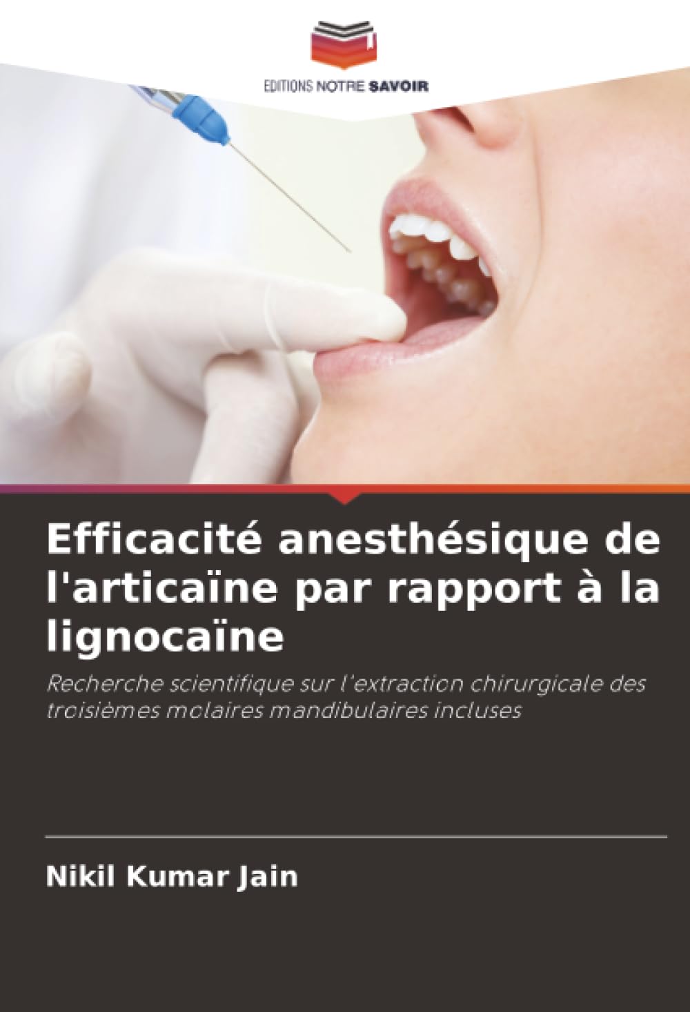Efficacité anesthésique de l'articaïne par rapport à la lignocaïne: Recherche scientifique sur l'extraction chirurgicale des troisièmes molaires mandibulaires incluses