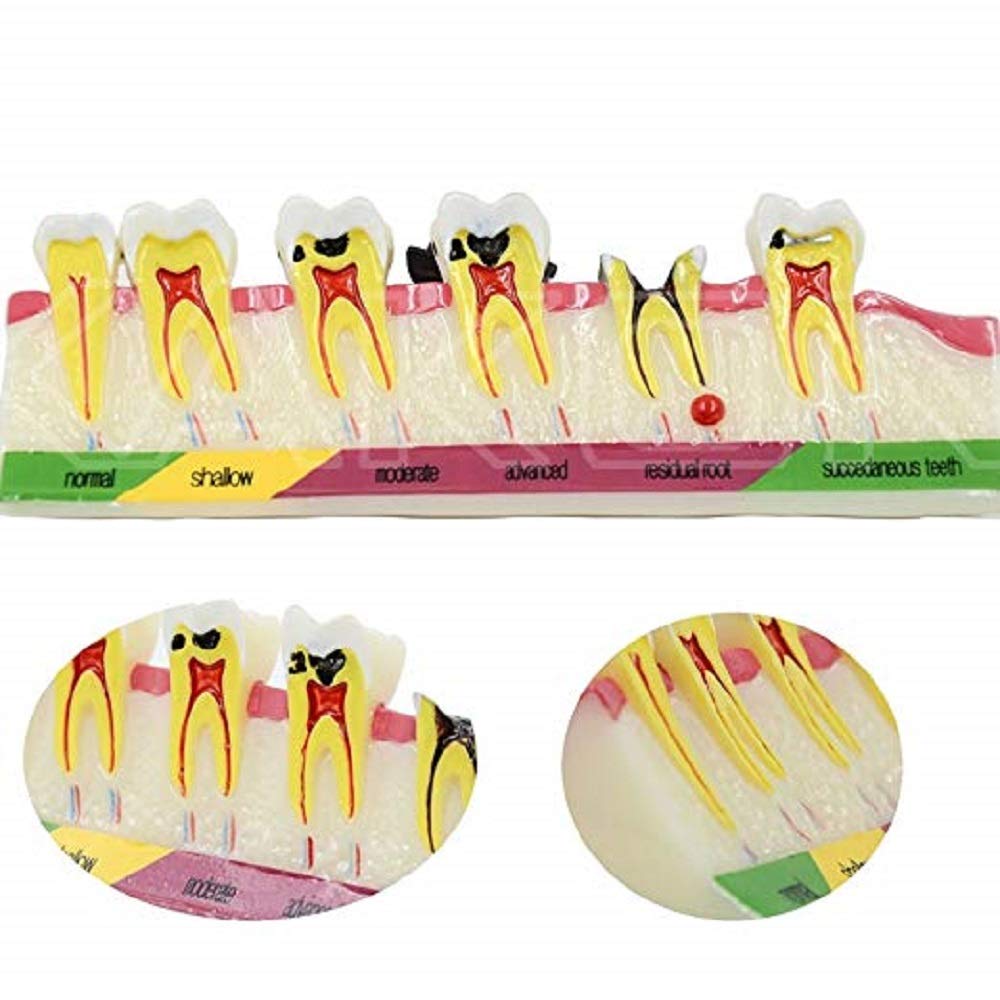 Buy TREE Dental Caries Analysis Model, Doctors And Patients Communicate