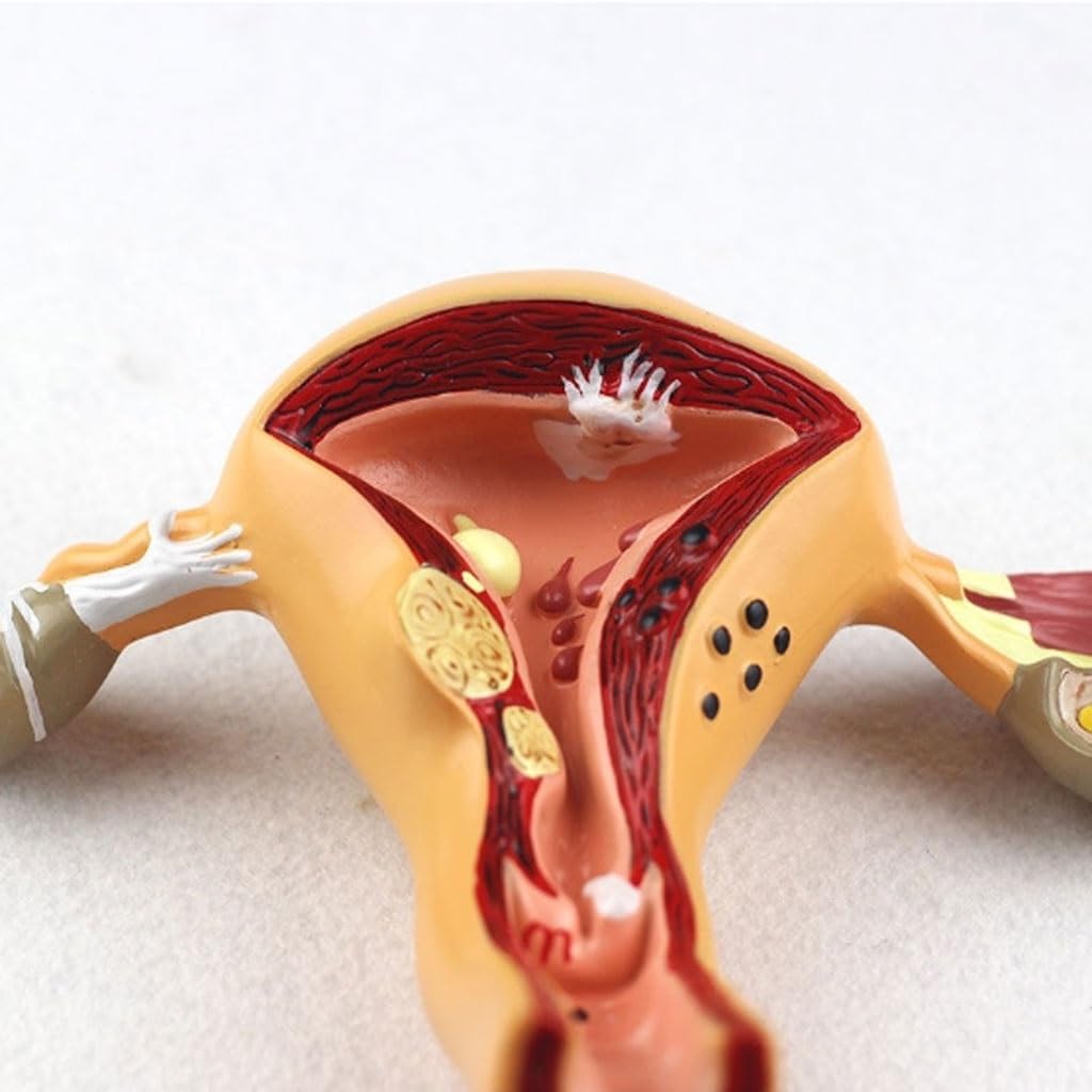 Modèle d'utérus pathologique présentant des maladies courantes. Représentation grandeur nature de l'organe reproducteur féminin montrant l'endométriose