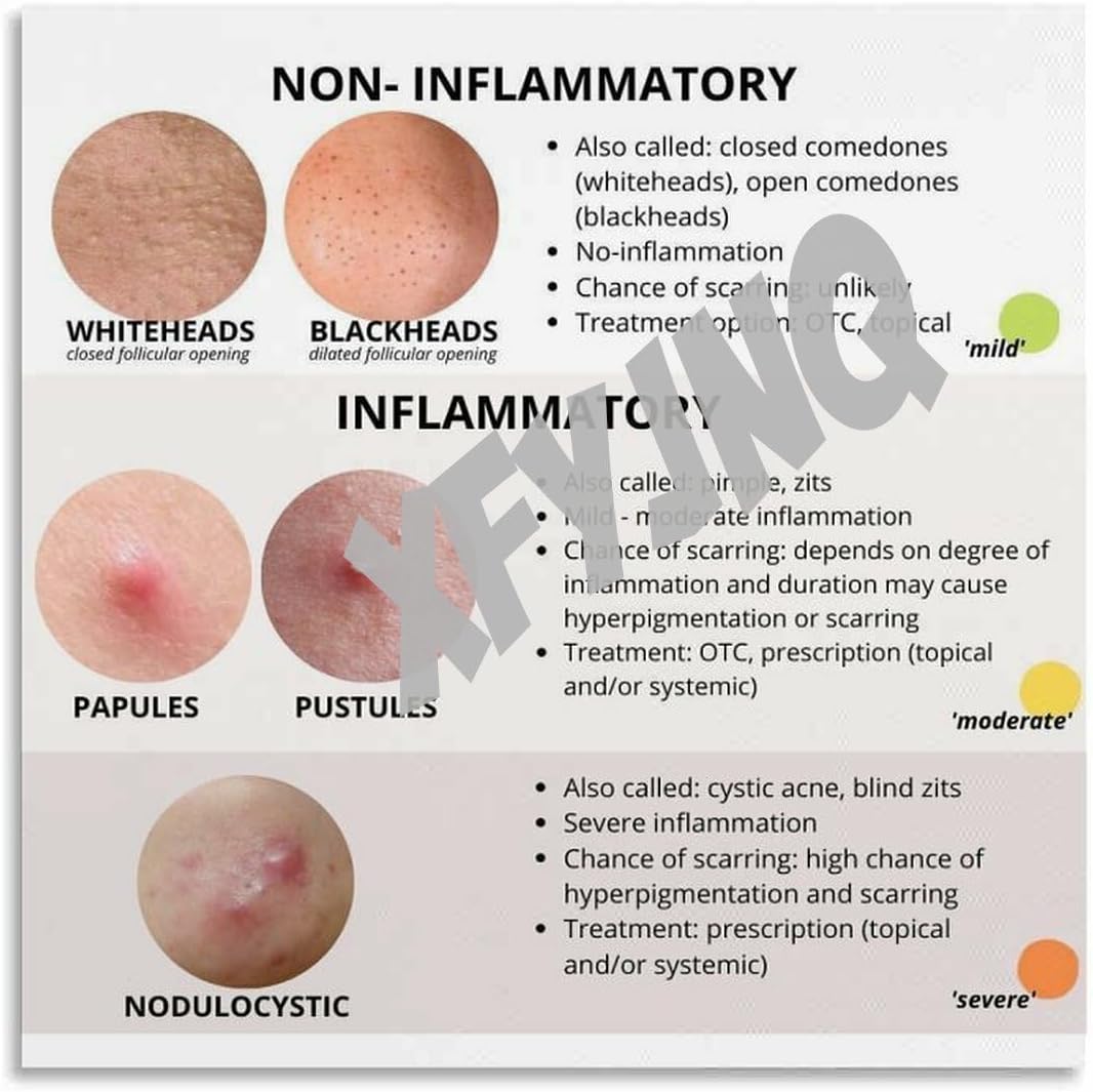 Inflammatory Acne Poster Treatment Guidelines Wall Art (1) Canvas for Bedroom Living Room Decor 12x12inch(30x30cm) Unframe-style