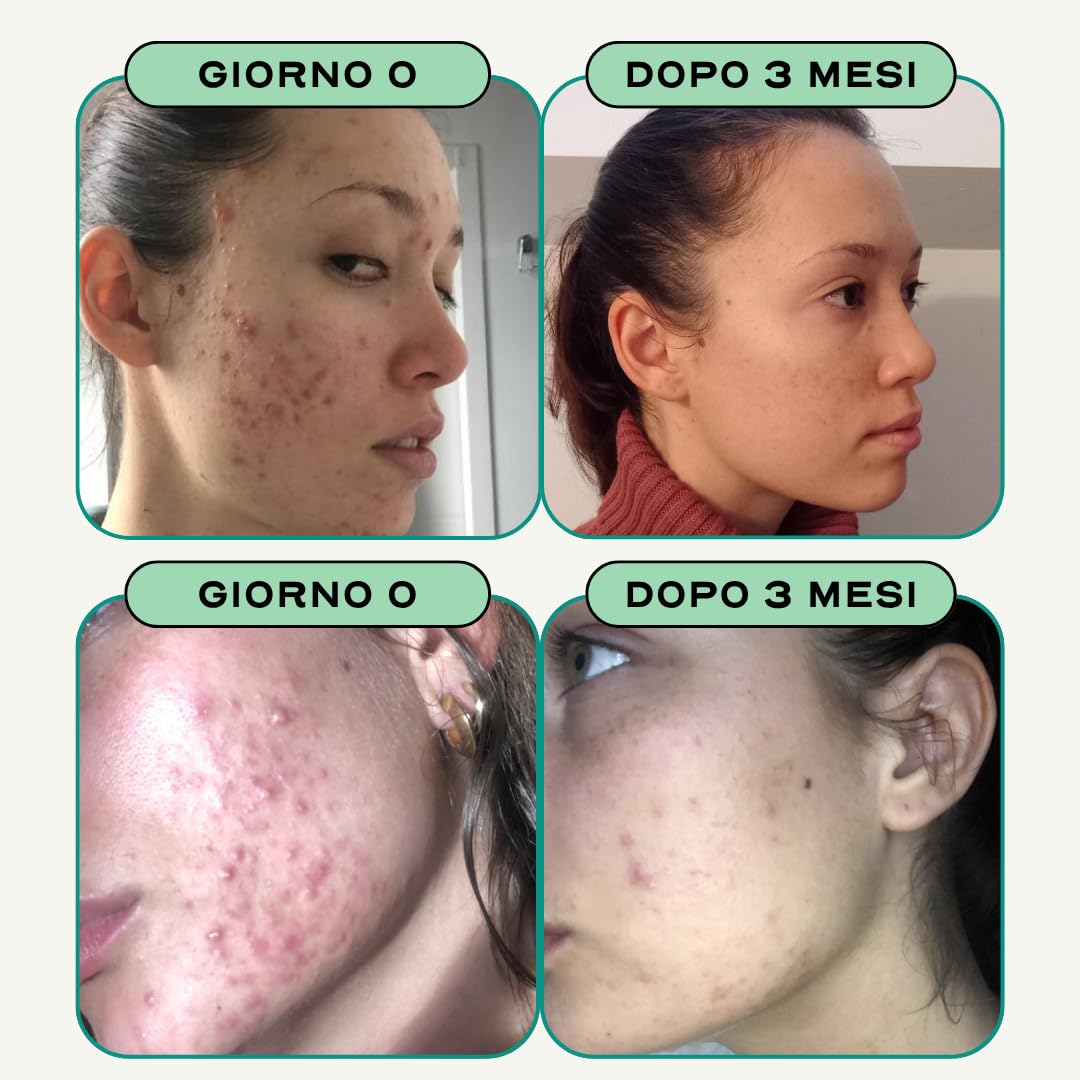 Circles Zinco Integratore contro Acne e Brufoli Compresse Vegan – CLEAR Detox per Viso e Corpo - con Bardana, Ortica e Rosmarino - Supporto Acne Ormonale Adulti