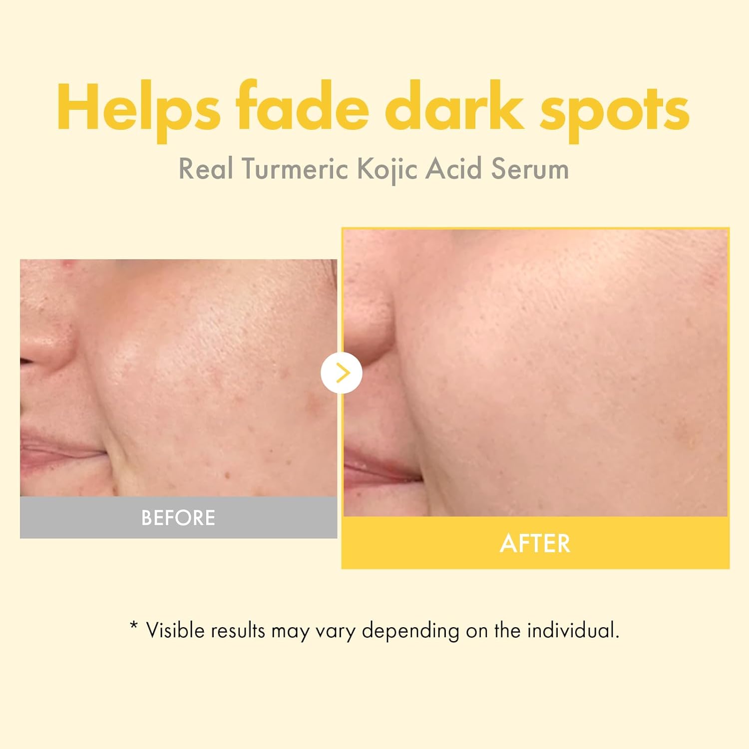 TOSOWOONG Real Turmeric Kojic Acid Serum - Brightening serum 7,000ppm Kojic Acid, 1,500ppm Turmeric, Alpha Arbutin, Astaxanthin, Glycolic Acid, Dark Spots, Freckle, Korean Skin Care, 33ml/1.11 fl.oz. - Image 4