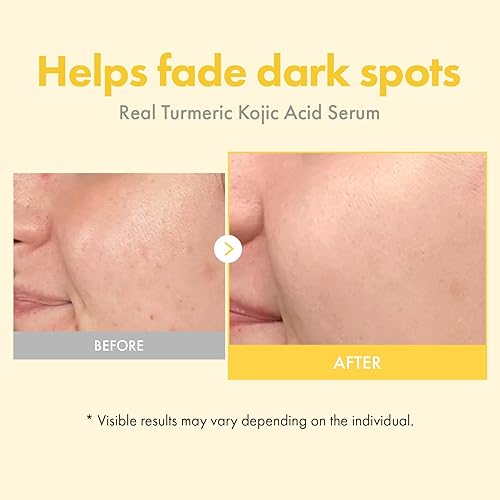 Miniatura 4 de TOSOWOONG Suero Real de Cúrcuma y Ácido Kójico, 7,000ppm de Ácido Kójico, 1,500ppm de Cúrcuma, Alfa Arbutina, Astaxantina, Ácido Glicólico, Para