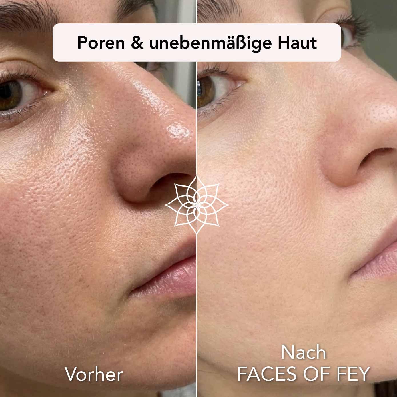 FACES OF FEY Derma roller 0,25 mm, 192 prawdziwe igły, 10% niacynamidu