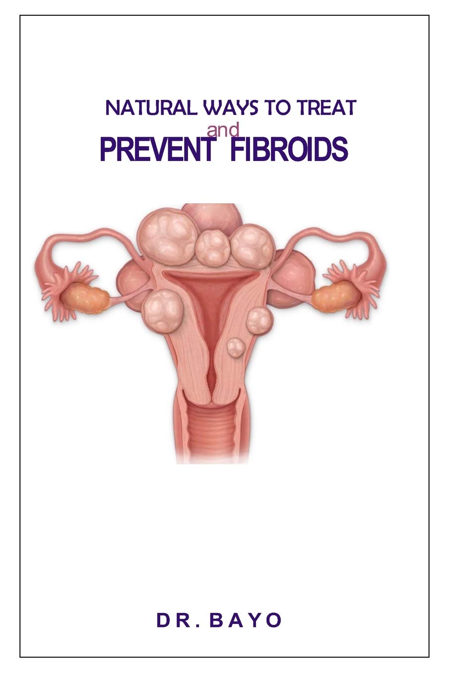 NATURAL WAYS TO TREAT AND PREVENT FIBROIDS Paperback – 31 Mar. 2020