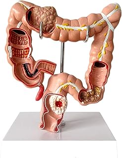 Study Model Human Large Intestine Anatomical Model Visceral Lesion Model - Colon Pathology Model PVC Human Anatomical Anatomy Digestive System Studying Teaching Model SaiFei