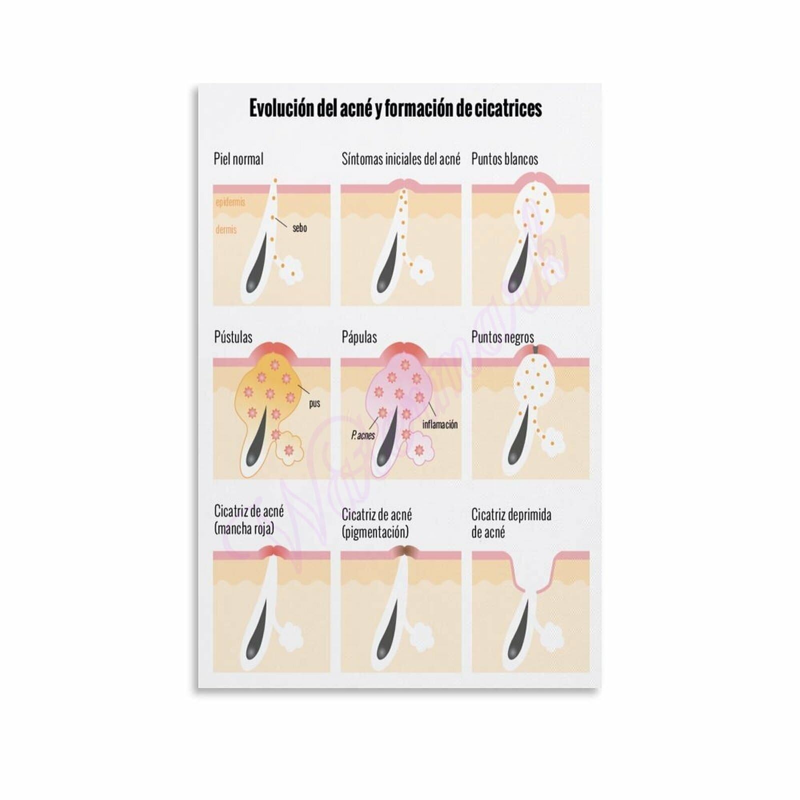 FOPURE Dermatology Chart Canvas Wall-Art Skin Anatomy Diagram Poster Layers of Skin Illustration for Office(Framed,16x24inch(40x60cm))
