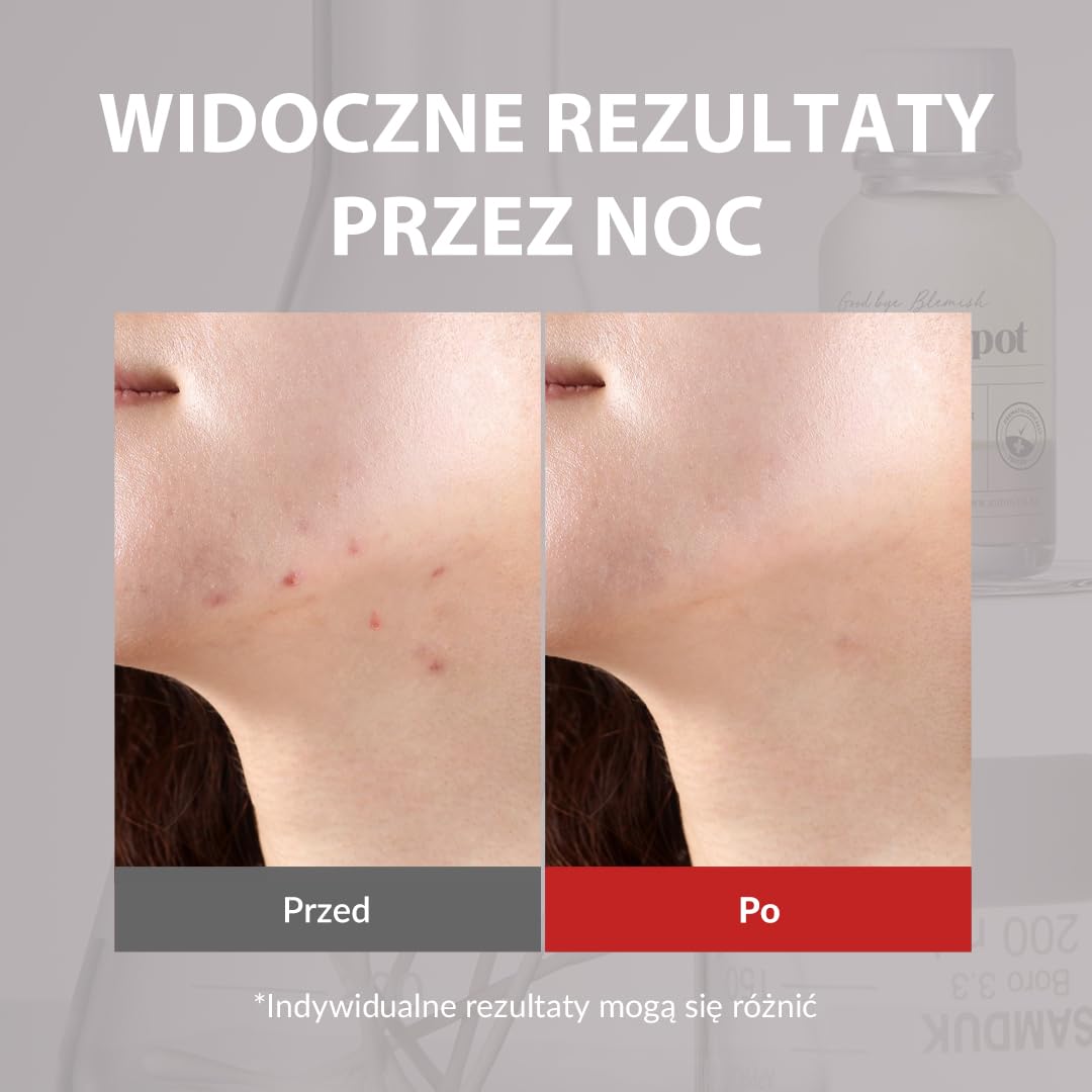 [Mizon] Tratament na Trądzik i Pryszcze, Nocna Pielęgnacja Plamek, Nocna Pielęgnacja Trądziku, Produkt z Kalaminą, AHA, BHA, Tratament Przełomowy (19 ml) Good Bye Blemish Pink Spot