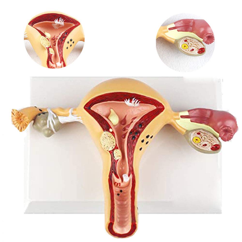 Sjdopulse Women's White Uterine Pathological Lesion Model, Reproductive System Dissection Model, Used For Doctor-Patient Communication And Medical Education
