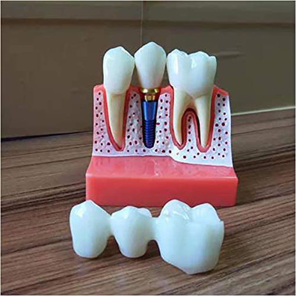 Modèle D'implant Dentaire Modèle D'éducation Dentaire Modèle D'implant Dentaire Degrete Modèle Dentaire sans Dents Modèle D'implant Dentaire Pratique Dental Workforce