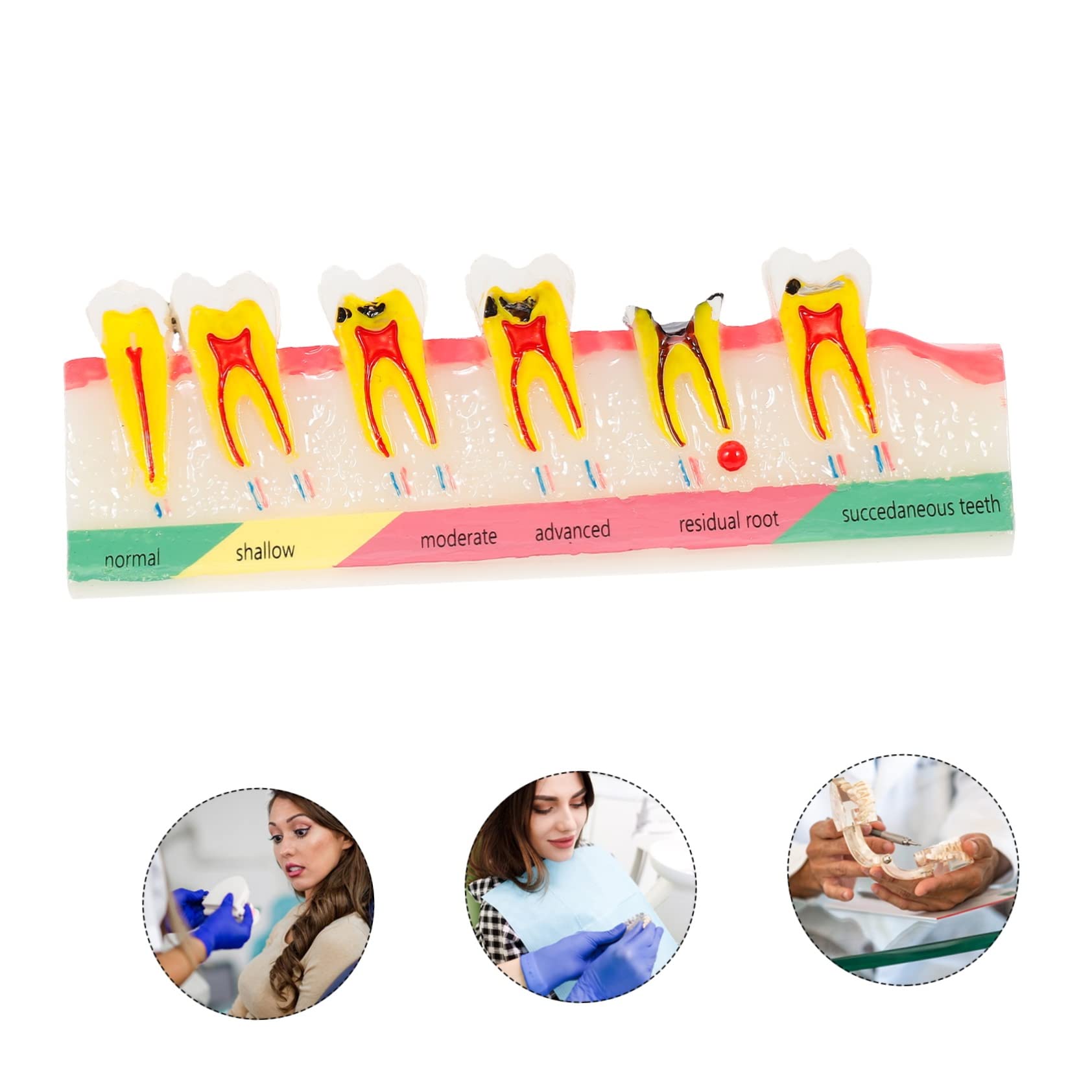 Alipis Modello Didattico di Denti Carie Resistente per Corsi Odontoiatrici, Strumento Dimostrativo per Studio e Lezioni di Igiene Orale, Modello Educativo Professionale per Studenti
