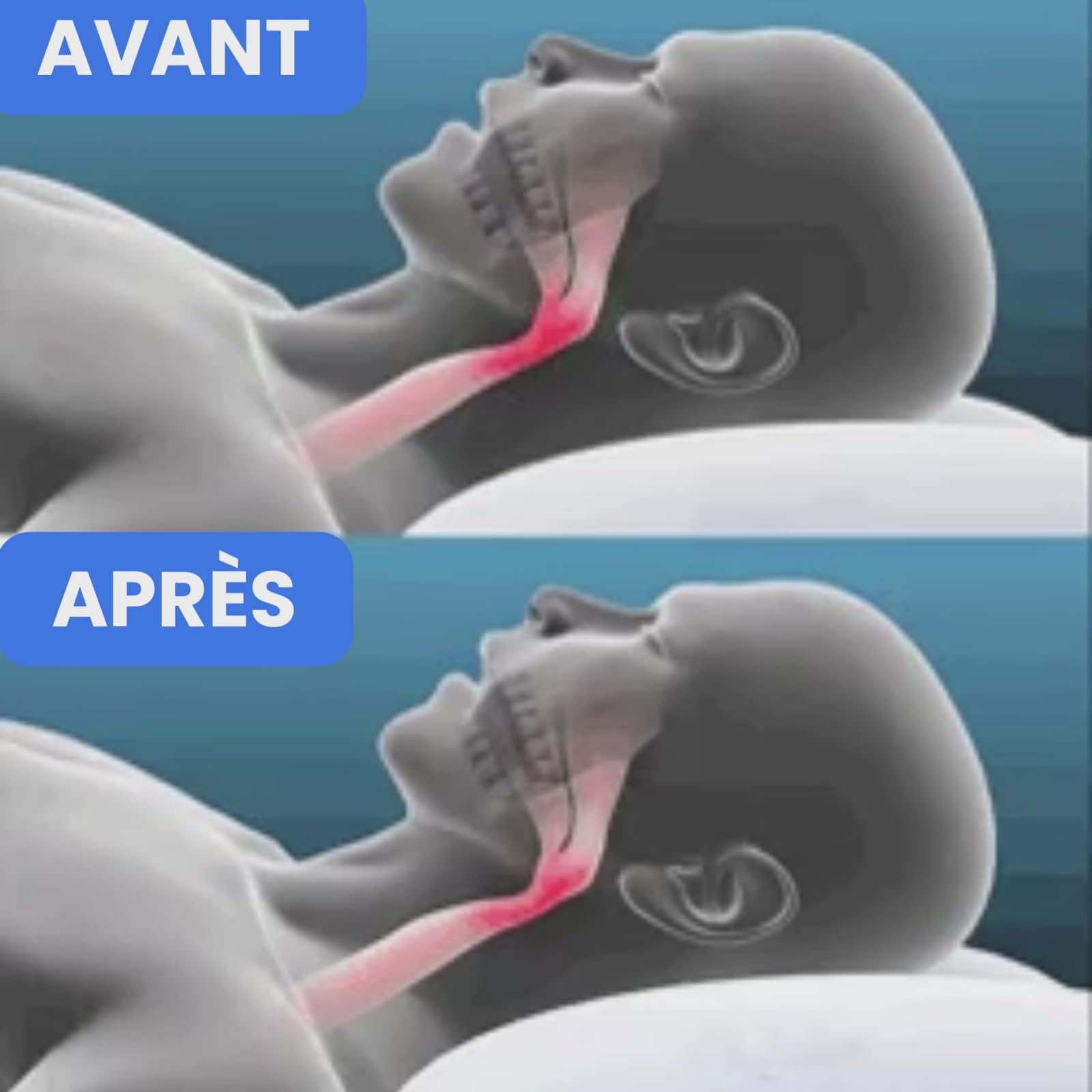santenor SanoRespire -Embout buccal antironflement，unisexe, dispositif multifonctionnel de réduction du ronflement, compact et portable, vous aidant à profiter d'un sommeil réparateur