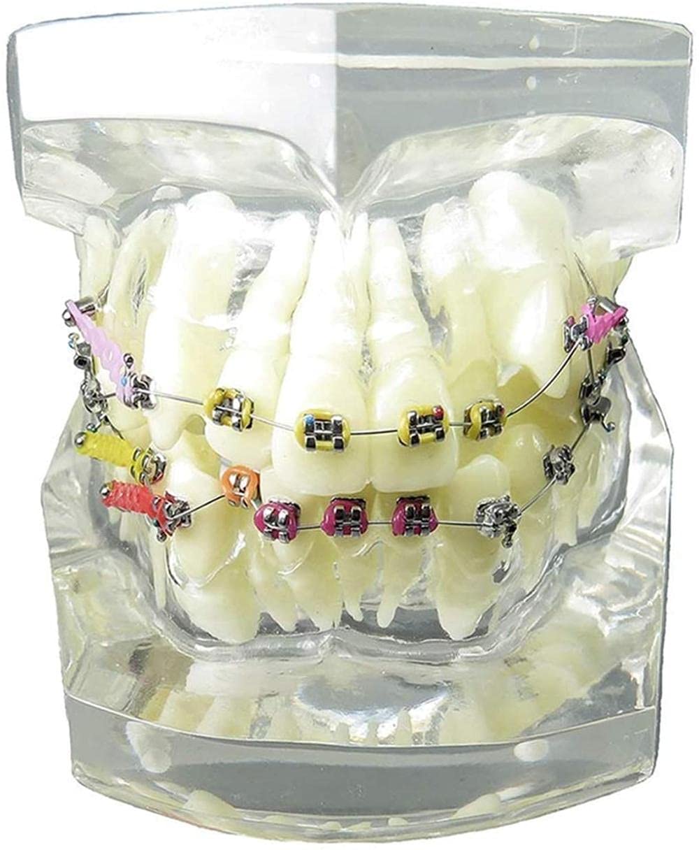Modèle dentaire malocclusion pour expliquer le traitement aux patients