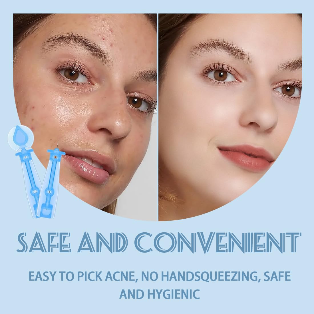100 Piezas Afilado Desechable Blackhead, Blemish Remover Acné Aguja, Herramienta Profesional Para La Eliminación De Puntos Negros E Imperfecciones