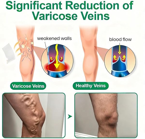 12 Unidades Target parche avanzado con para varices Parche con Microagujas para Venas Varicosas, Tratamiento Natural para Piernas, Apto para Todo Tipo de Piel (8PC+Verde) - 3