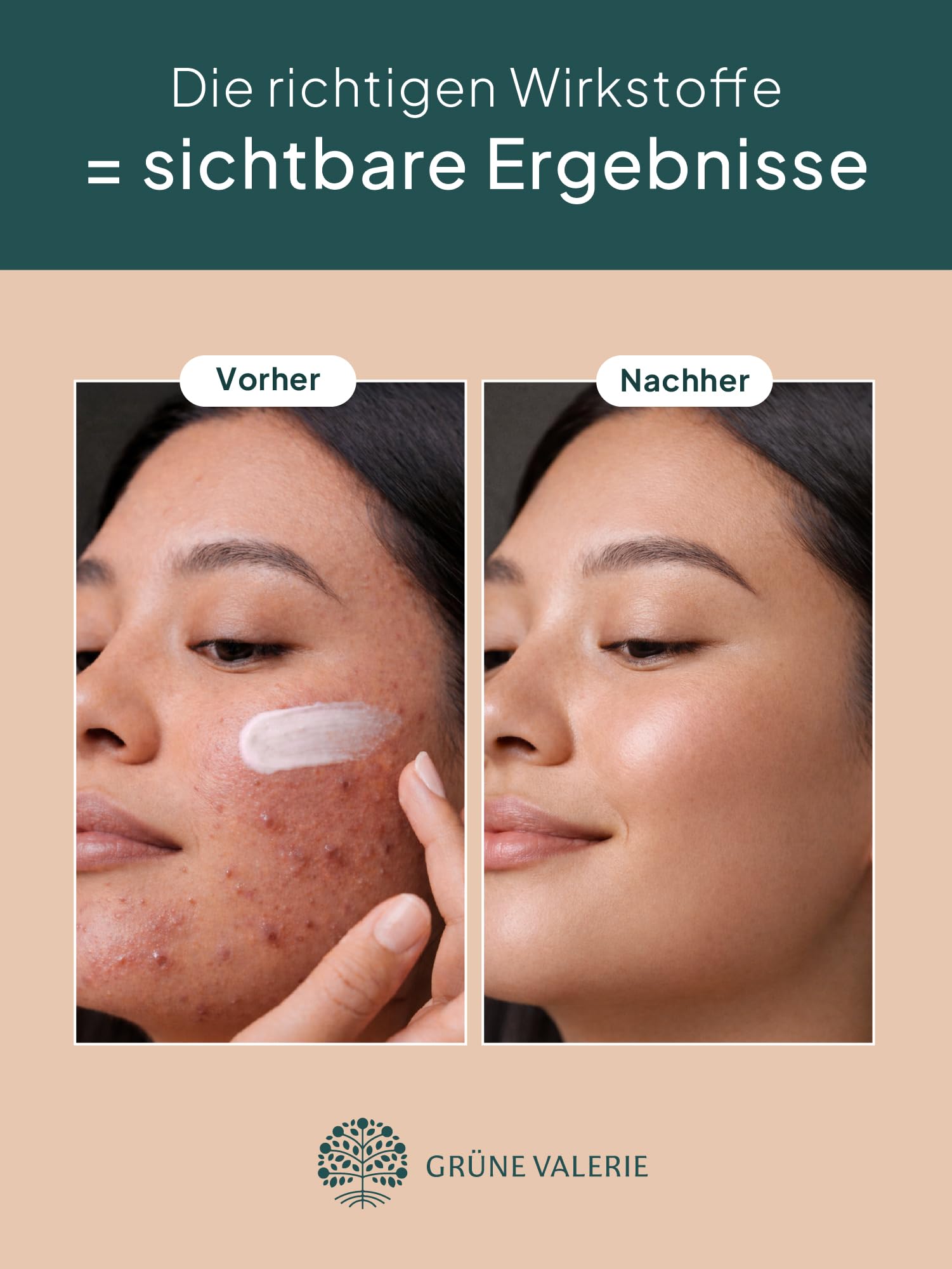 GRÜNE VALERIE® Zinksalbe gegen Pickel 100ml [HOCHDOSIERT] - Mit Teebaumöl, Salicylsäure & Niacinamid - Anti Pickel Creme - Hautbalance - Zink gegen Akne - Gesichtspflege unreine Haut mit Propolis