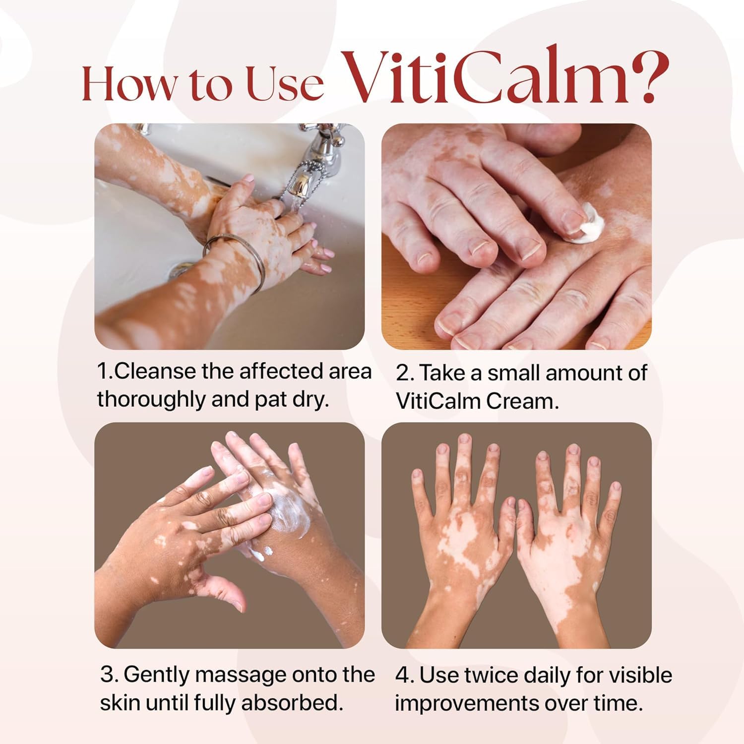VitiCalm Cream for Vitiligo | White Patches Repigmentation, Relieve Vitiligo Skin, and Helps to Restores Natural Skin Color | Dr. Megha Chaturvedi | 100ml Cream