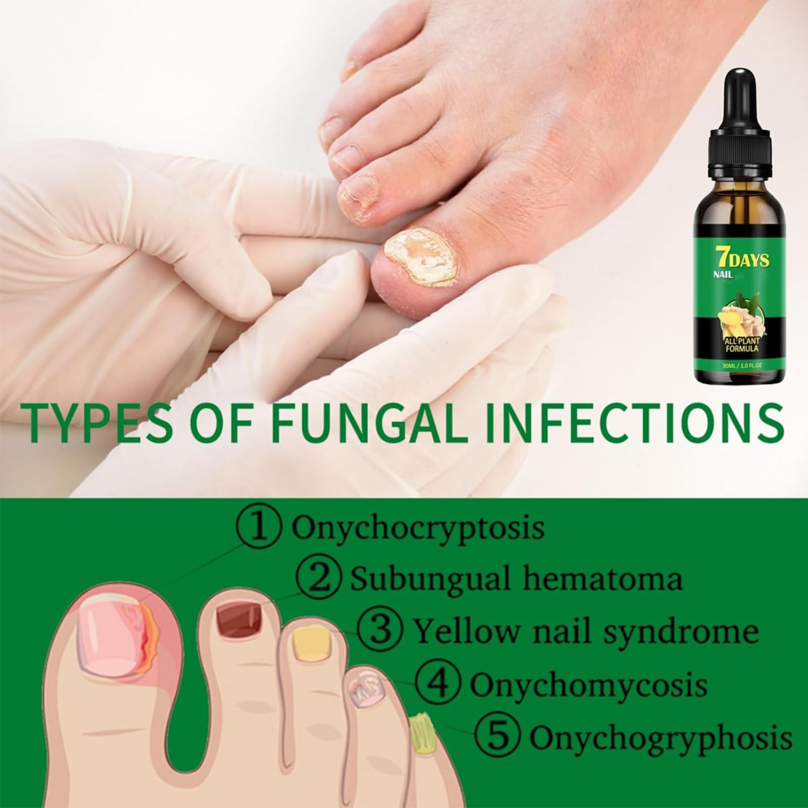 Tratamiento de hongos de uñas de 7 días, soporte de uñas de jengibre CUIDADO, 1 FL.OZ Multi-usose uñas de reparación de suero, para uñas finas, frágiles, peladas y agrietadas (2pcs)