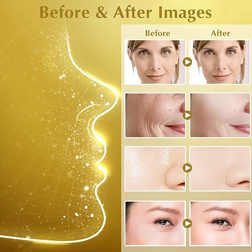 Miniatura 7 de Juego de levantamiento de hilos de proteína hilo de proteína soluble y combinación de nano esencia dorada hilo de colágeno absorbible para