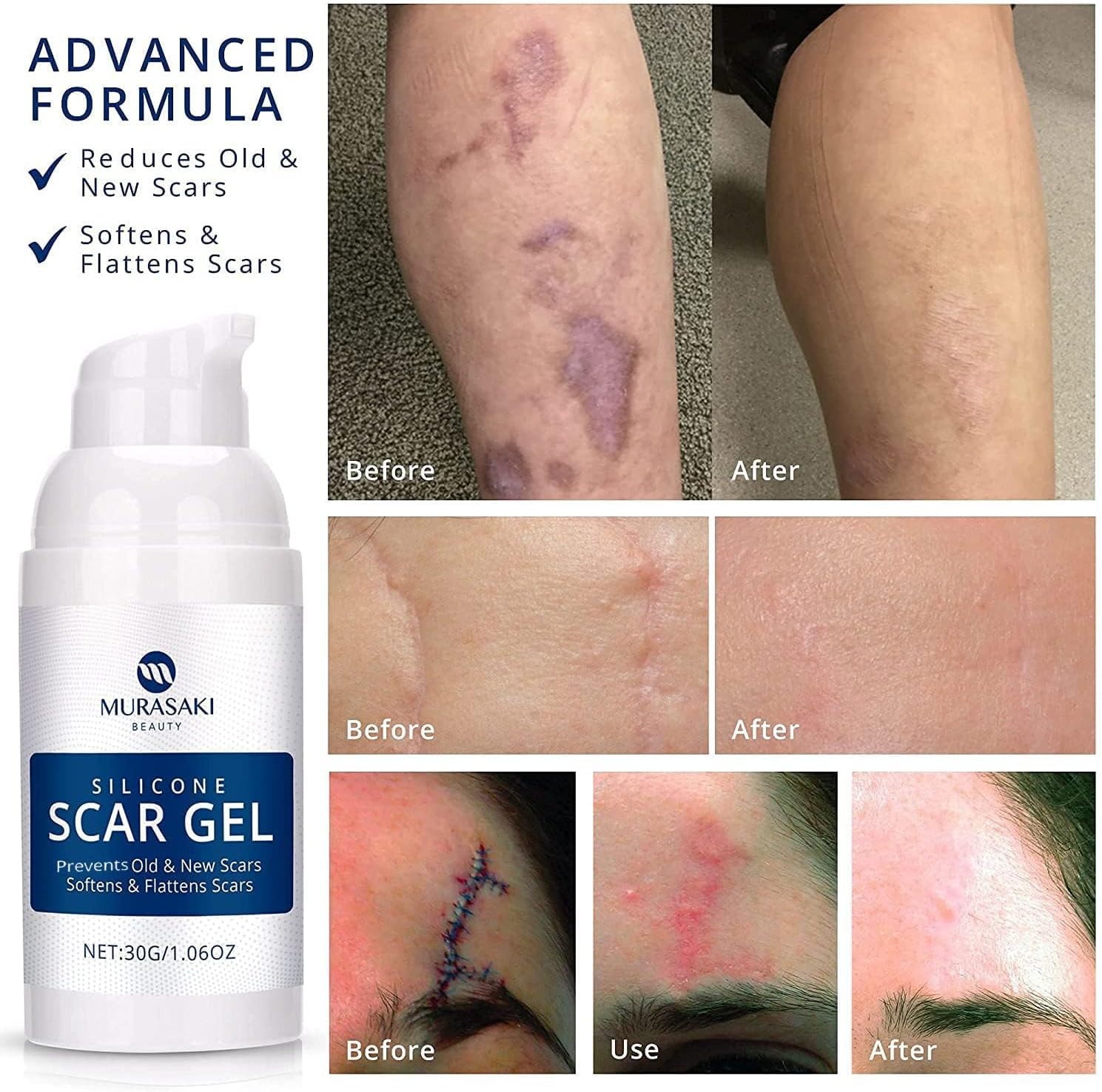100% Silicone Scar Gel Scar Cream - Advanced Scar Gel for Old and New Scars - Image 3