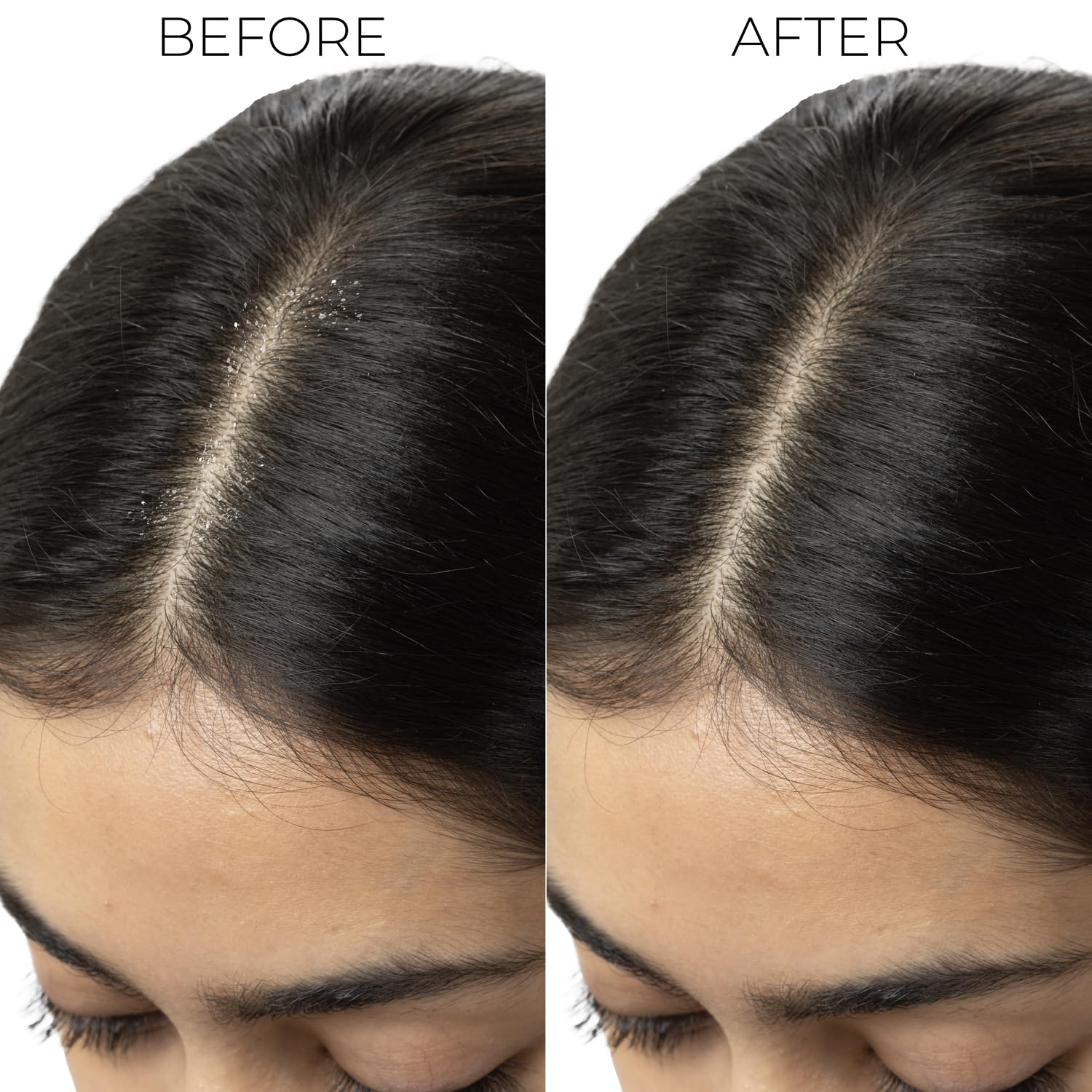 Professional Dandruff Control Shampoo | Anti Dandruff Shampoo for Women & Men | Shampoo for Dandruff & Itchy Scalp Relief | Reduces Flakes from 1st Wash | 300 ml 3