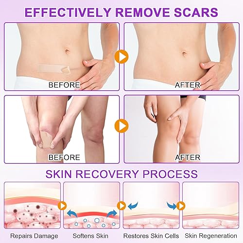 Miniatura 5 de Hojas de silicona para cicatrices, cinta de silicona para cicatrices (1.6 x 60 pulgadas), cinta de cicatriz de grado médico para cicatrices