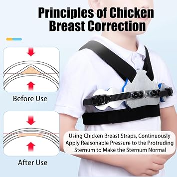 Pectus Carinatum Orthosis Brace, Medical Ribs Valgus Orthosis Braces, Sternum Protrusion Fixation Splint, Adjustable Size Long-Lasting Wear